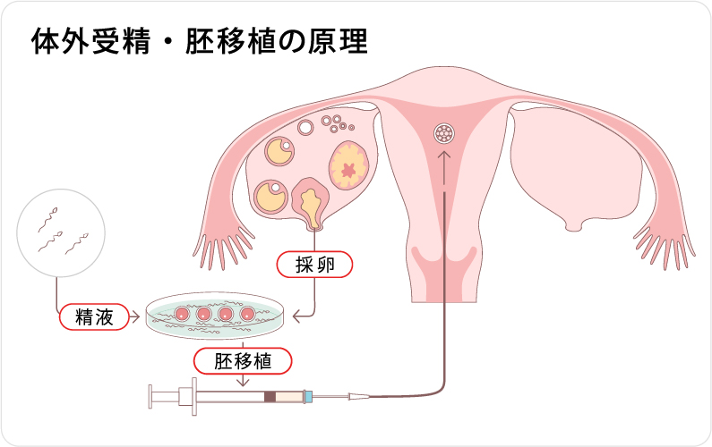 体外受精・胚移植の原理