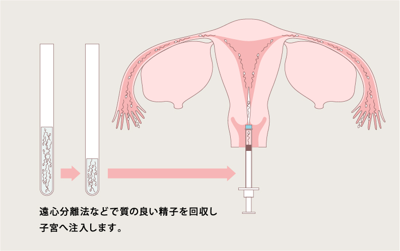 人工授精の様子