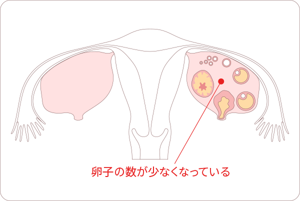不妊の原因「卵巣因子」図解　卵子の数が少なくなっている