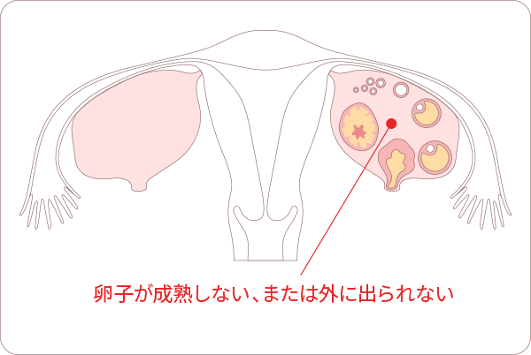 不妊の原因「排卵因子」図解　卵子が成熟しない、または外に出られない