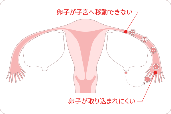 不妊の原因「卵管因子」図解　卵子が子宮へ移動できない。卵子が取り込まれにくい。