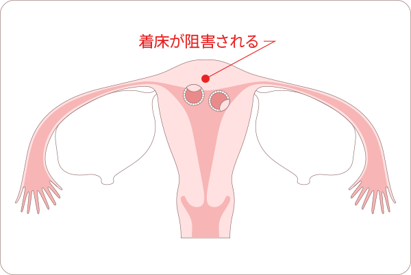 不妊の原因「子宮因子」図解　着床が阻害される