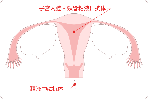 不妊の原因「免疫因子」図解　子宮内腔・頸管粘液に抗体。または精液中に抗体。