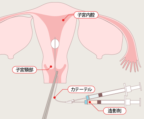 子宮卵管造影の解説図
