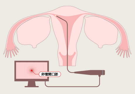 子宮鏡の解説図